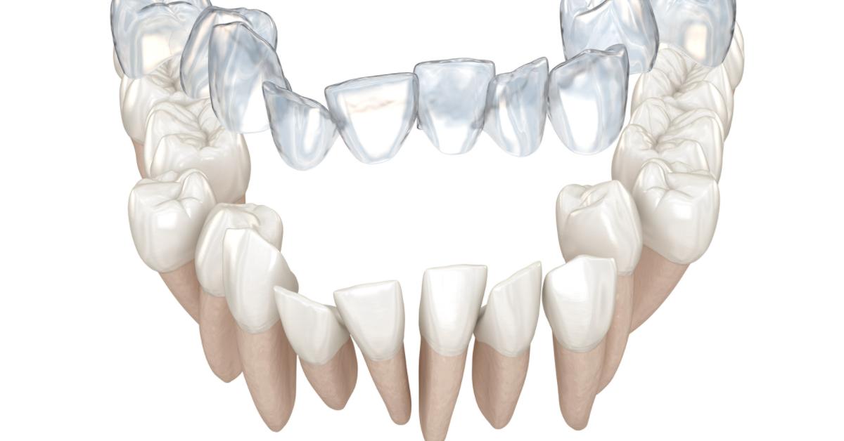 Clincheck Invisalign braces